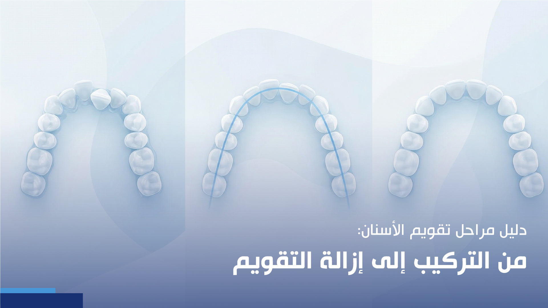 دليل مراحل تقويم الأسنان: من التركيب إلى إزالة التقويم
