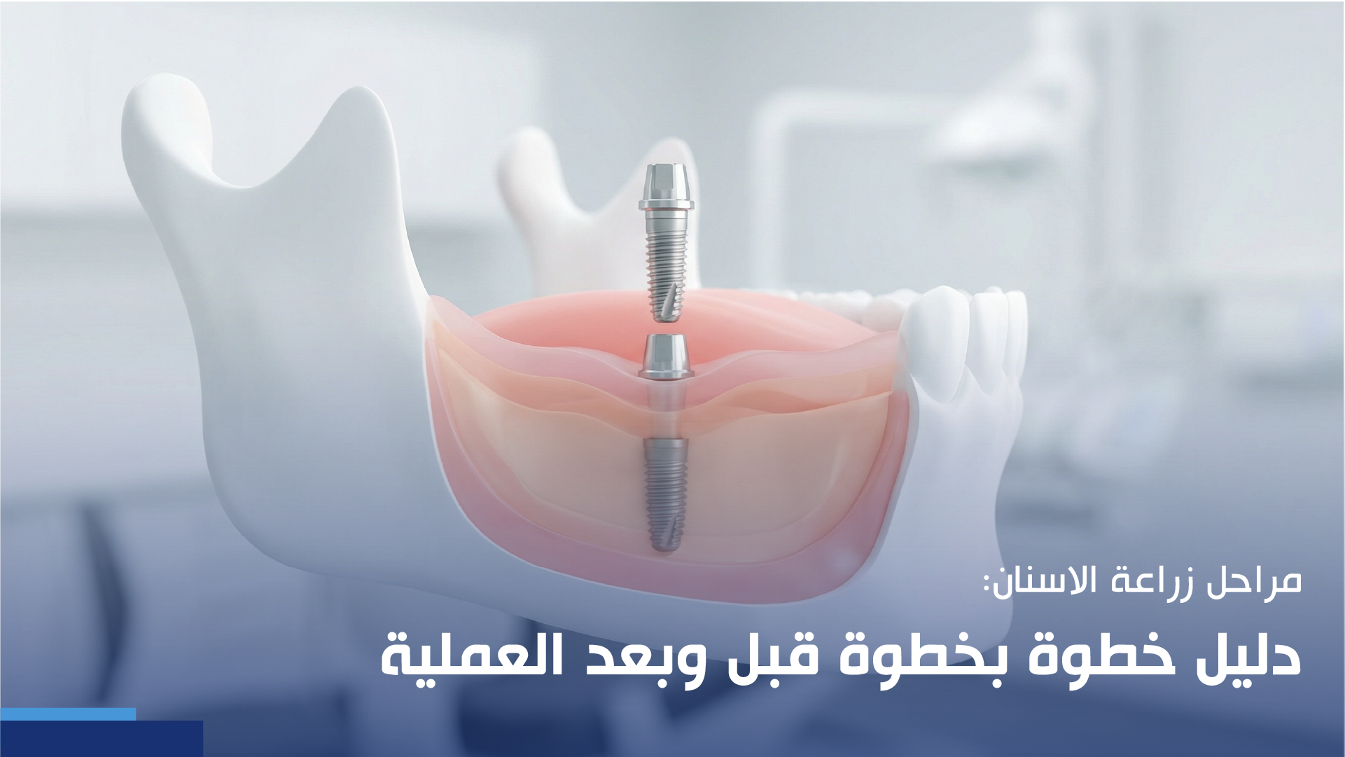 مراحل زراعة الاسنان