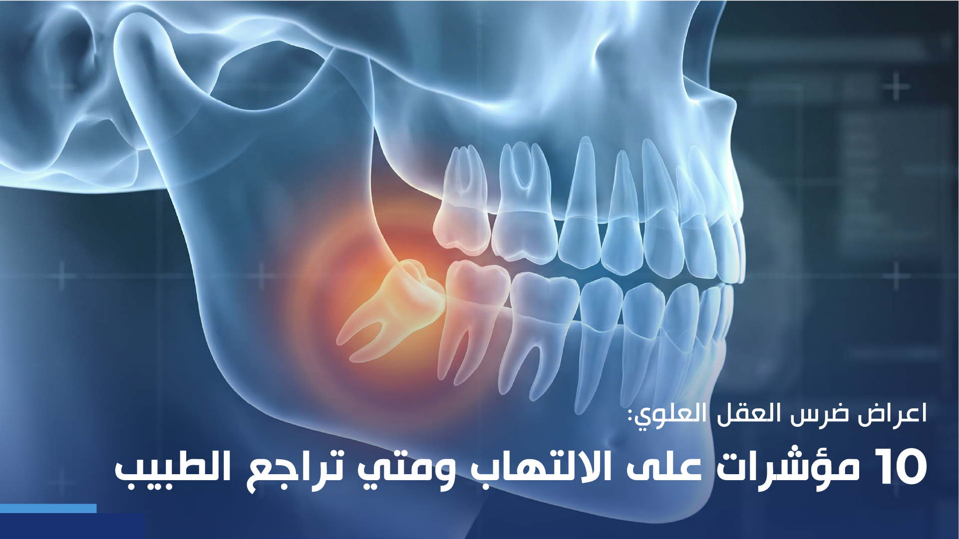 اعراض ضرس العقل العلوي