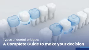 types of dental bridges