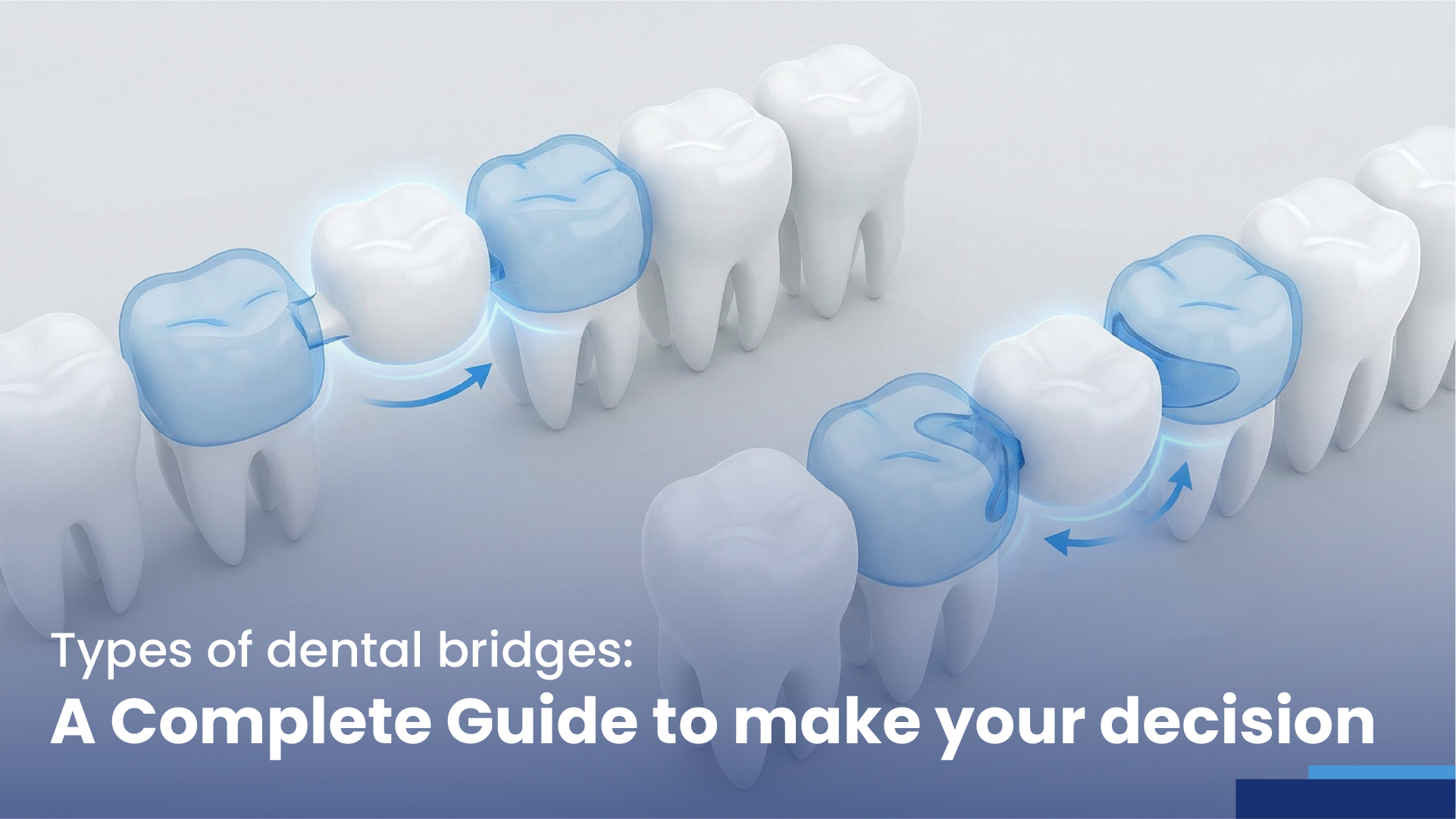 types of dental bridges