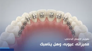 تقويم الاسنان الداخلي