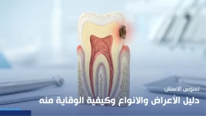 تسوس الاسنان