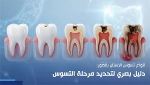انواع تسوس الاسنان بالصور