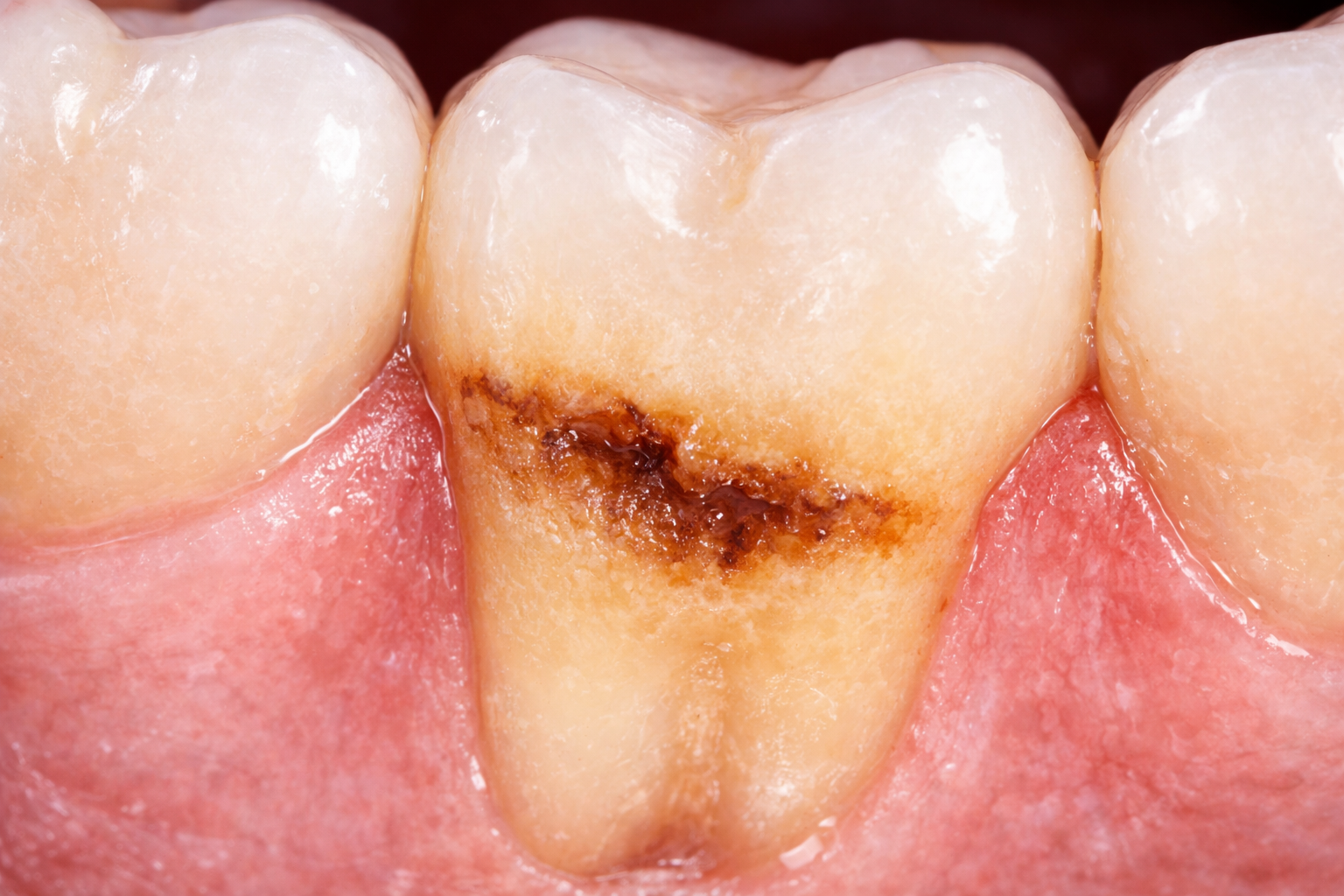 تسوس الجذور