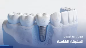 عيوب زراعة الاسنان