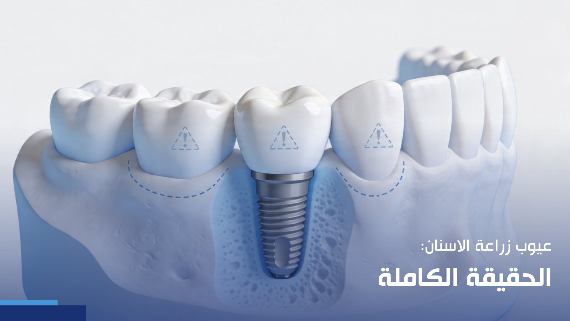 عيوب زراعة الاسنان