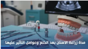 مدة زراعة الاسنان بعد الخلع