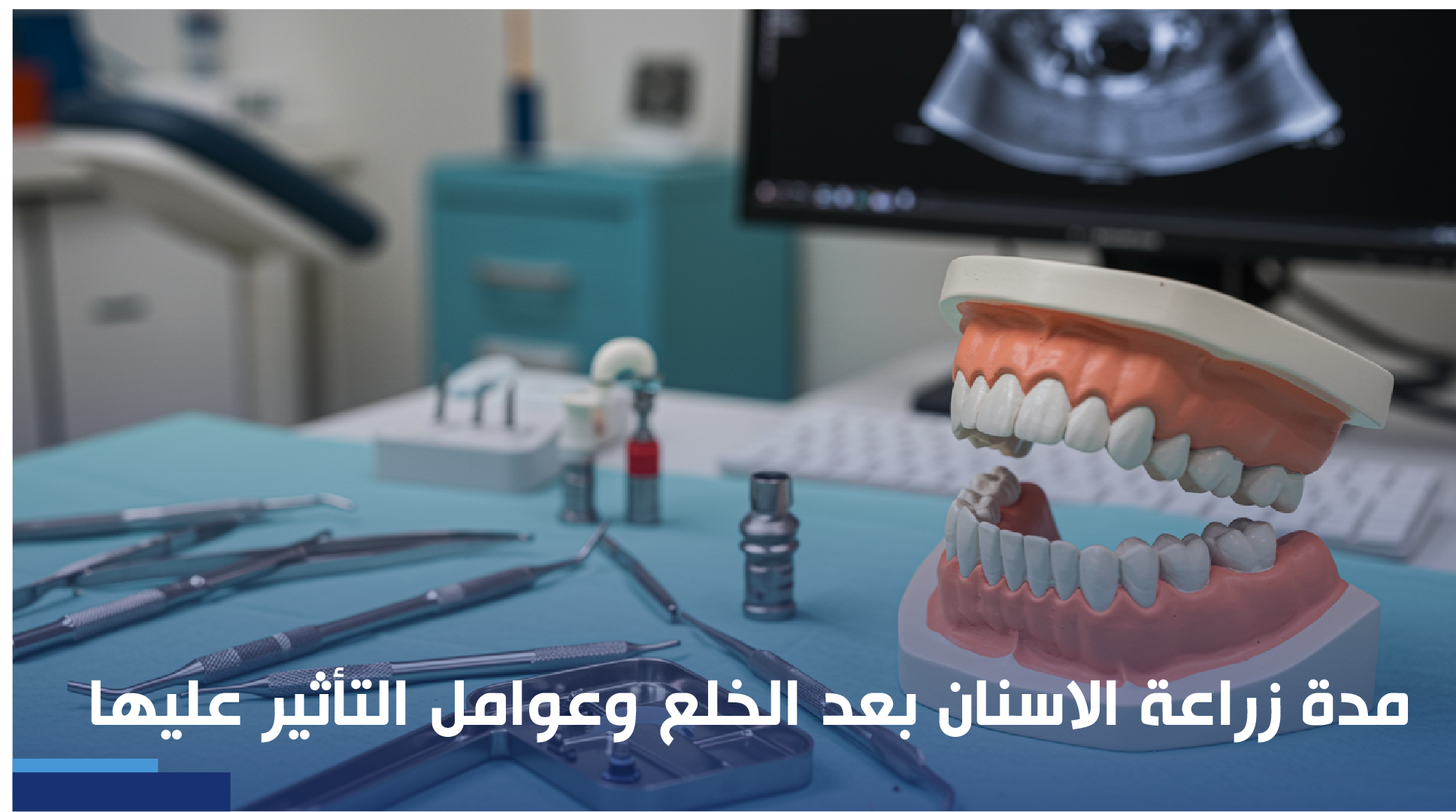 مدة زراعة الاسنان بعد الخلع
