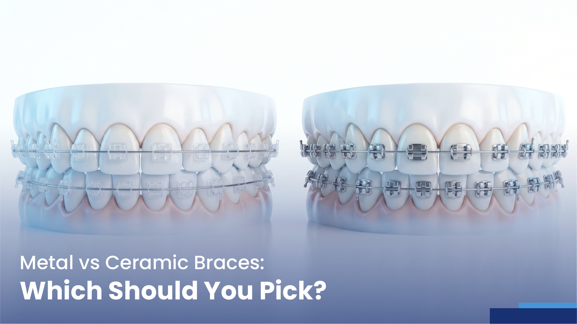 metal vs ceramic braces