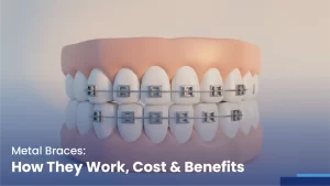 metal braces