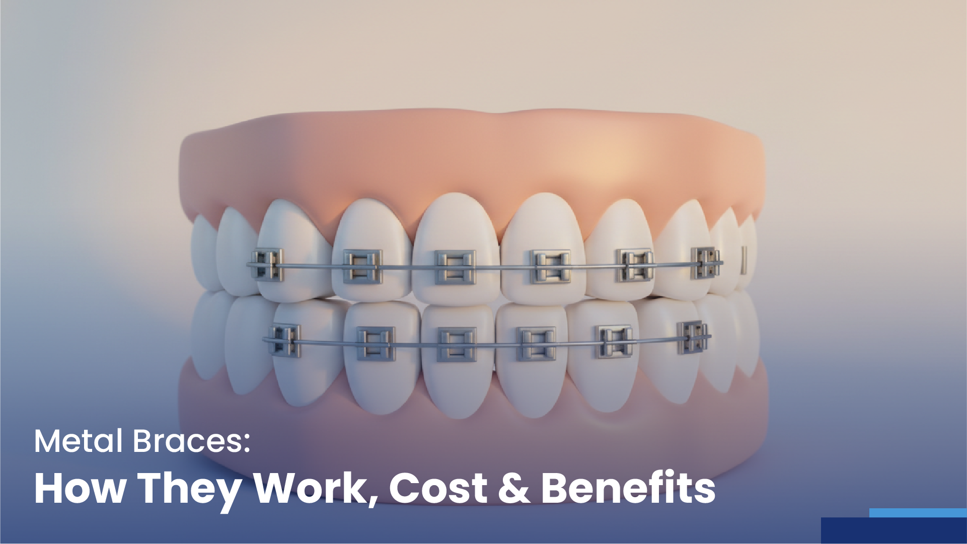 metal braces