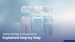 dental bridge components