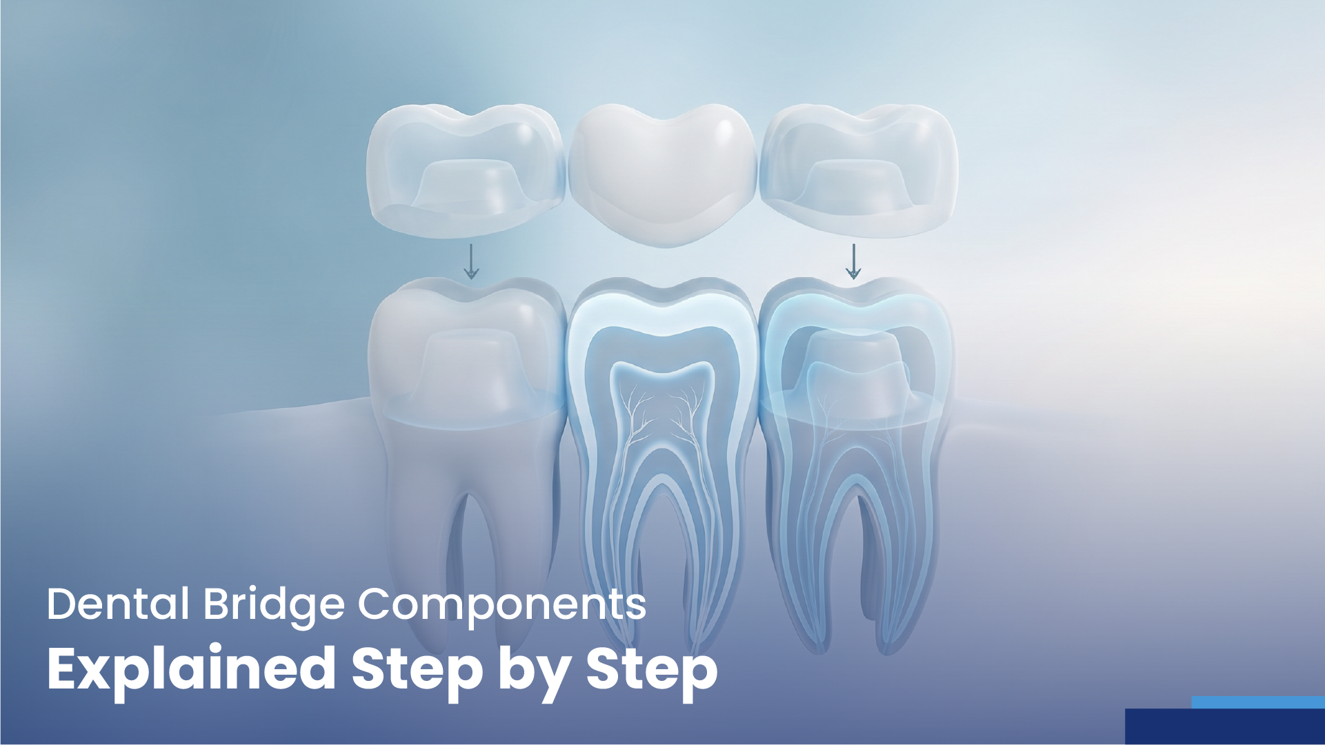 dental bridge components