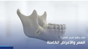 متى يطلع ضرس العقل
