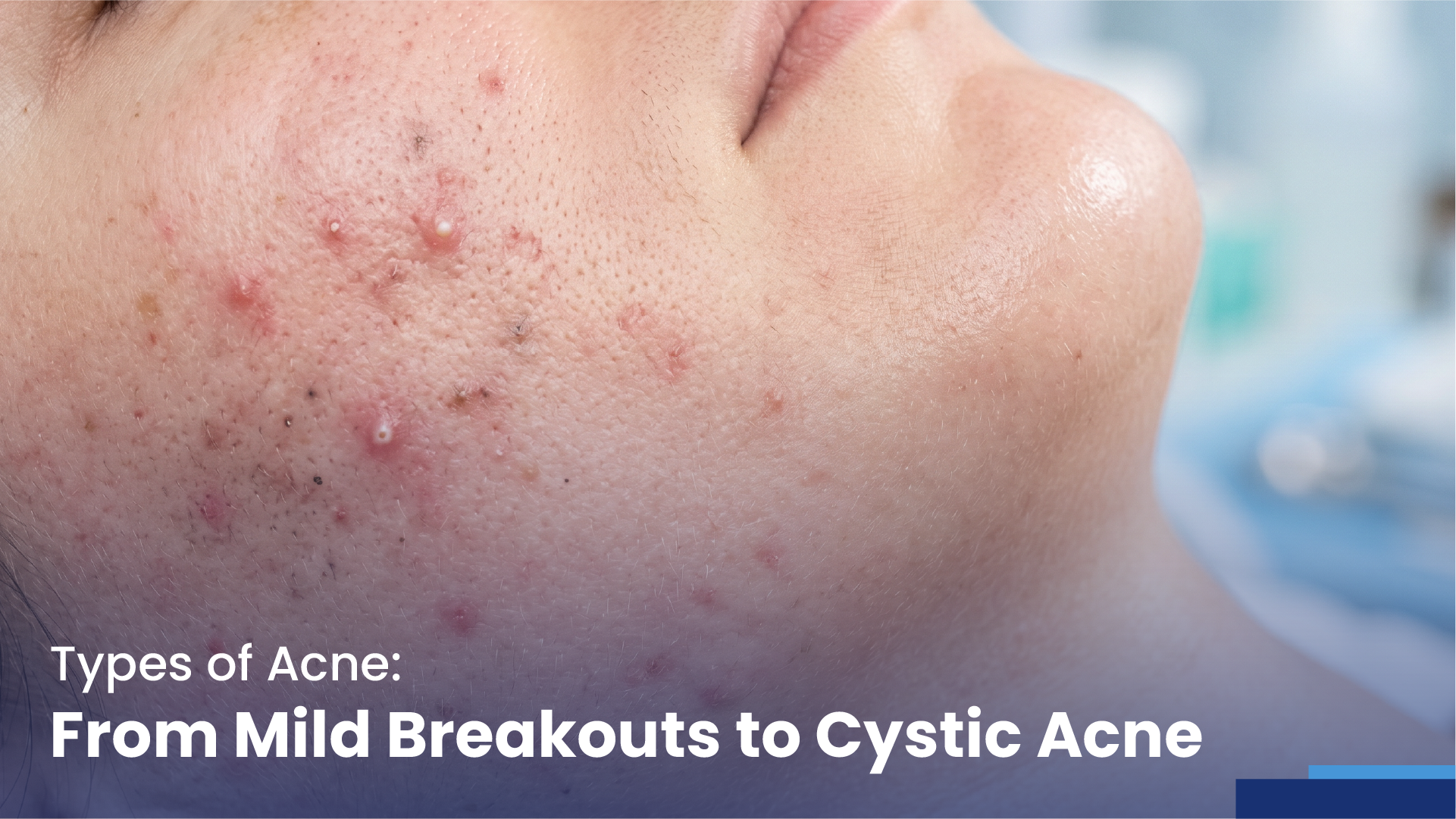 types of acne