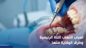 اسباب التهاب اللثة