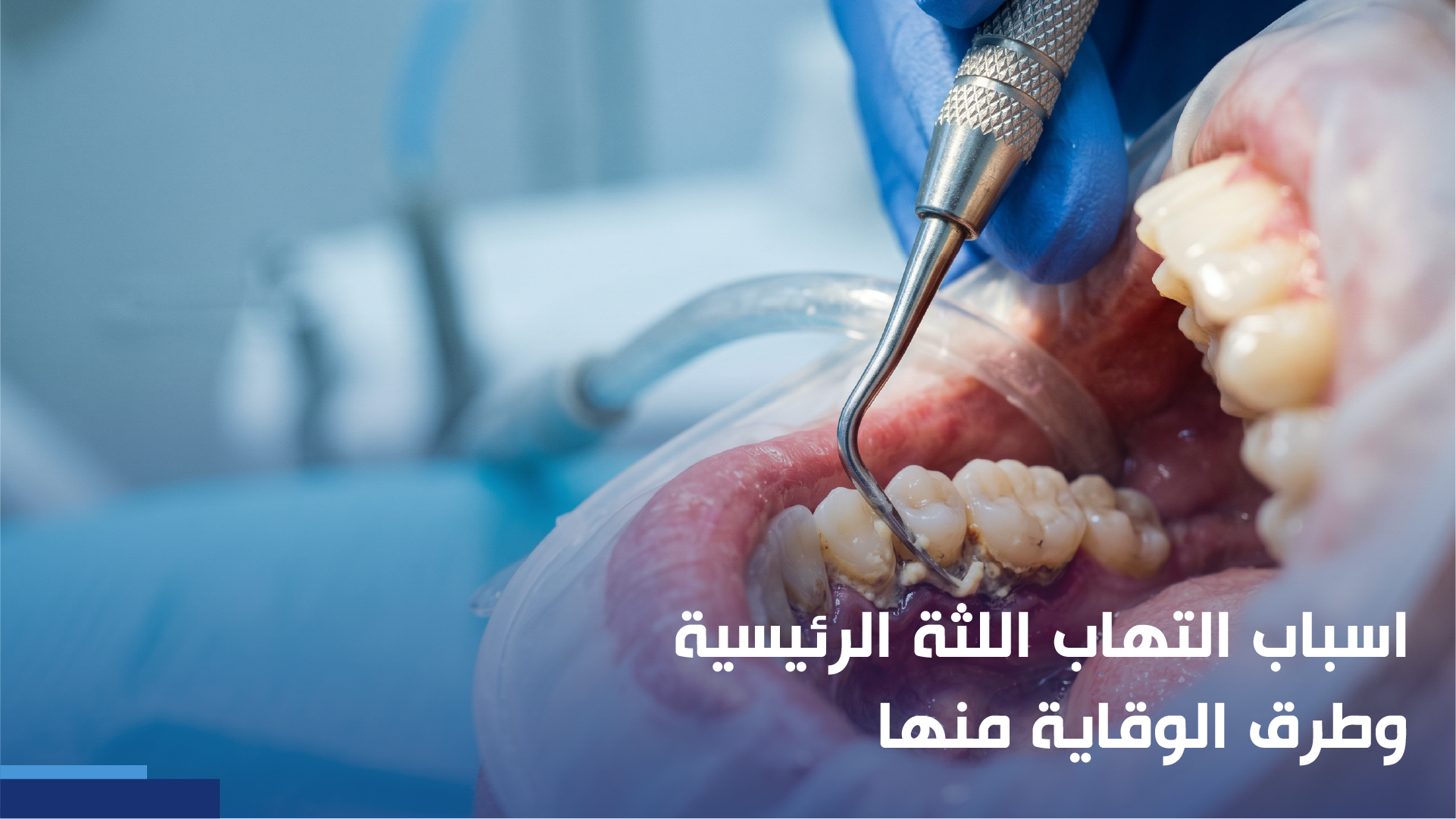 اسباب التهاب اللثة