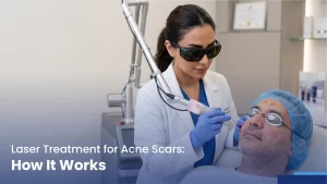 laser treatment for acne scars