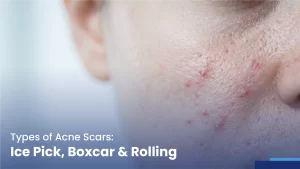 types of acne scars