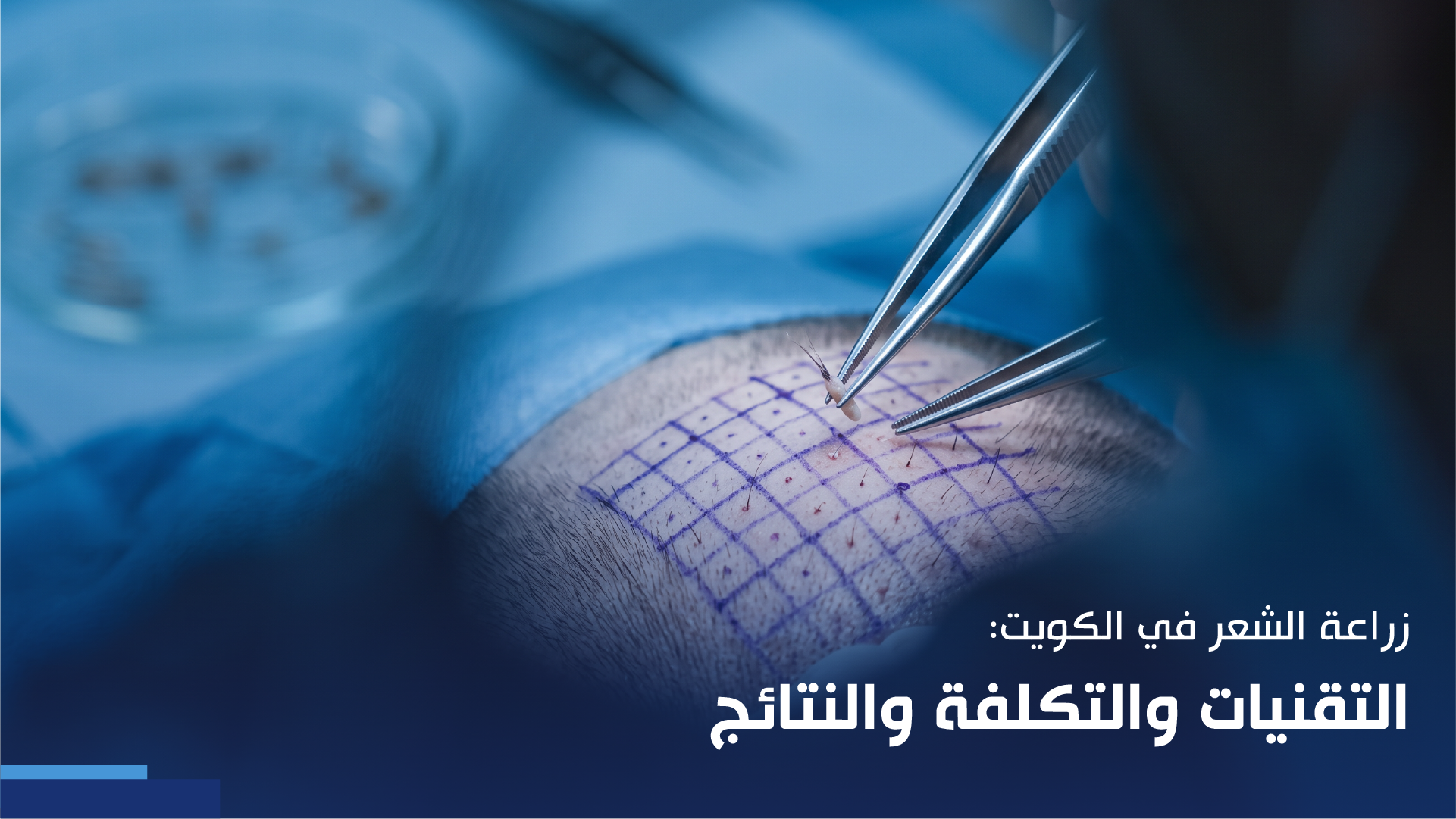 زراعة الشعر في الكويت