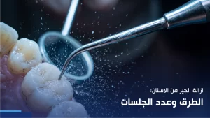 ازالة الجير من الاسنان